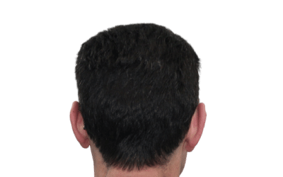 Tratamiento de Alopecia androgenética en Valencia Clínica capilar del Doctor De Felipe : en qué consiste y cómo combatirla