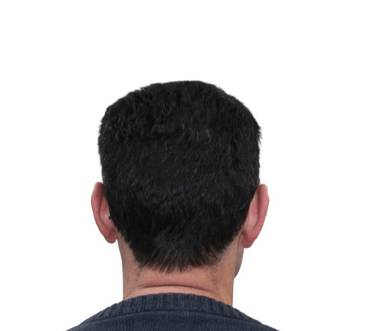 Tratamiento de Alopecia androgenética en Valencia Clínica capilar del Doctor De Felipe : en qué consiste y cómo combatirla