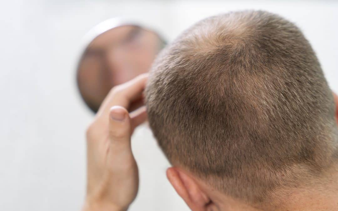Caída de pelo por estrés