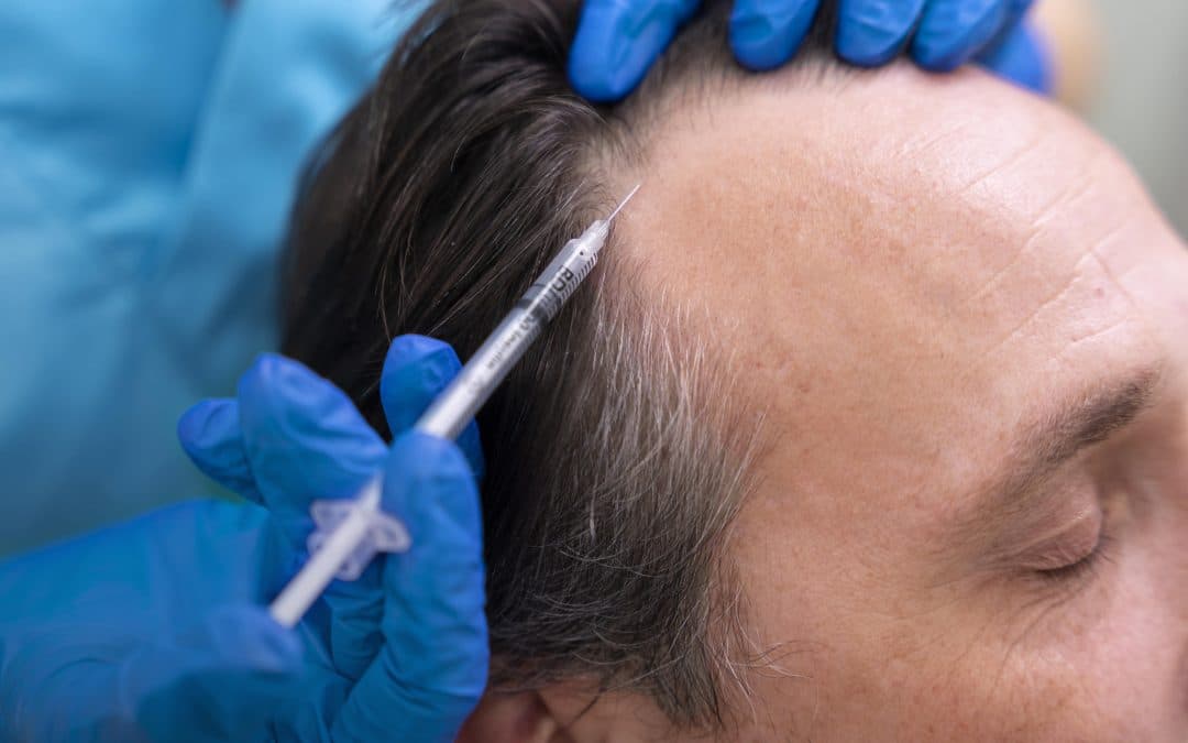 Postoperatorio injerto capilar consejos ¿Qué debes tener en cuenta en el postoperatorio de injerto capilar?