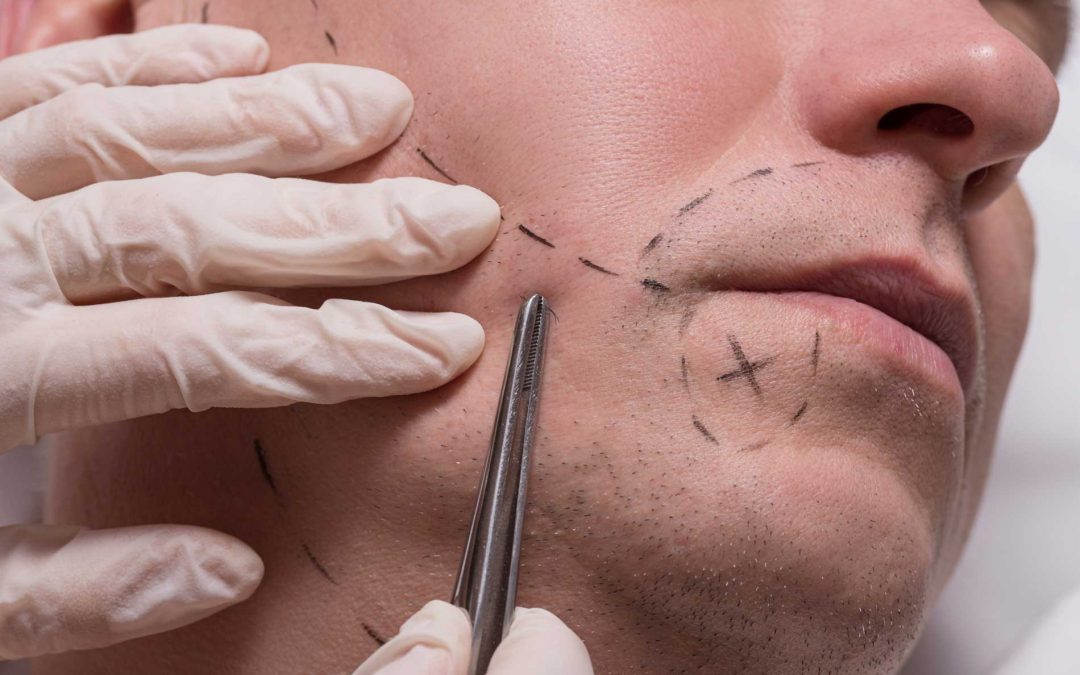 Injerto de barba en Valencia Clínica capilar del Doctor De Felipe
