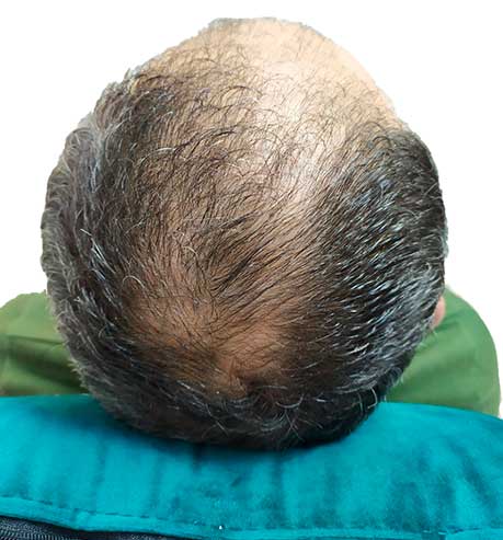 Mesoterapia capilar en Valencia Clínica capilar del Doctor De Felipe