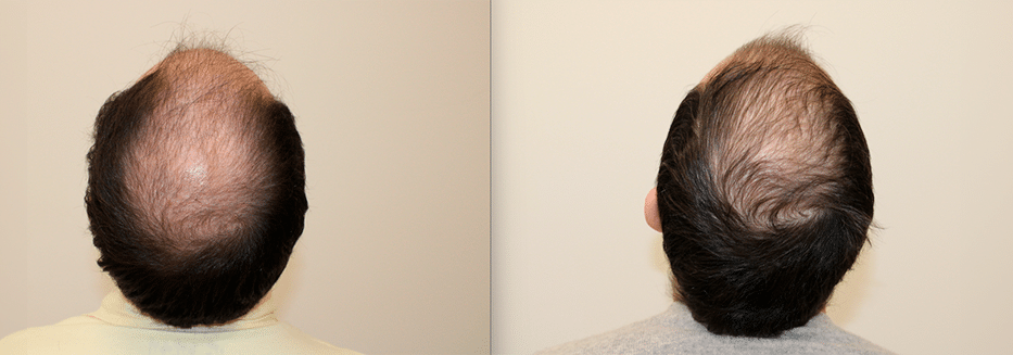 Mesoterapia con aminoacidos para el pelo coronilla