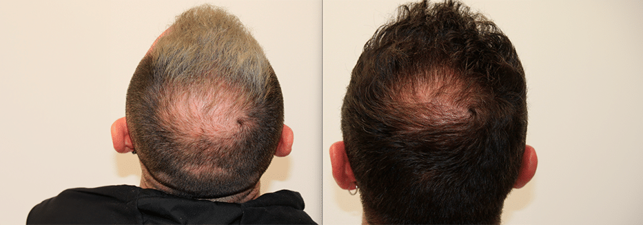 Mesoterapia con biotina realizada por el doctor de felipe
