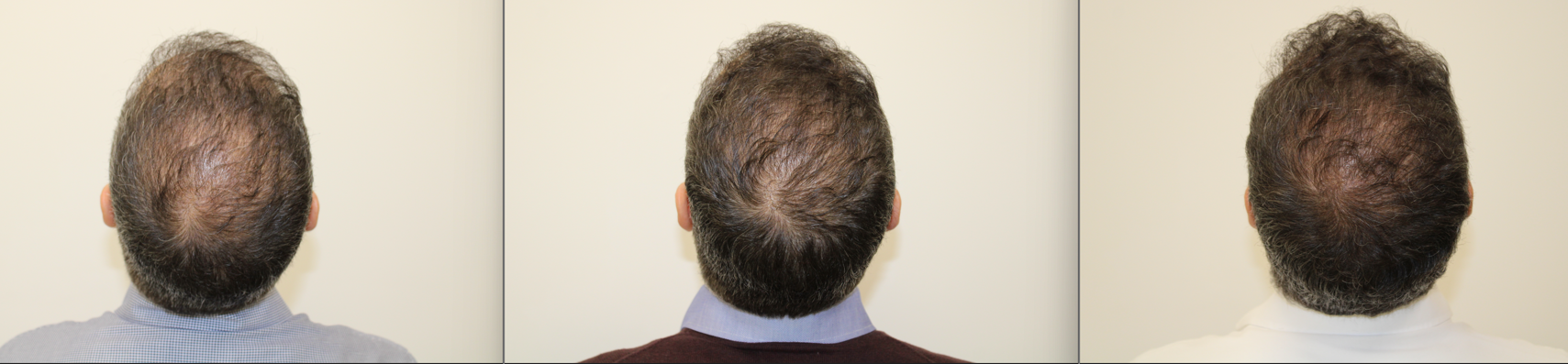 Mesoterapia con factores biológicos Doctor De Felipe
