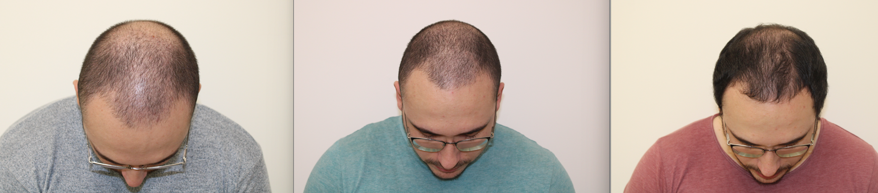 Mesoterapia de biorevitalización doctor De Felipe