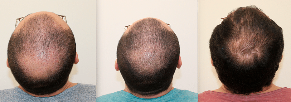 Mesoterapia de biorevitalización para el cuero cabelludo