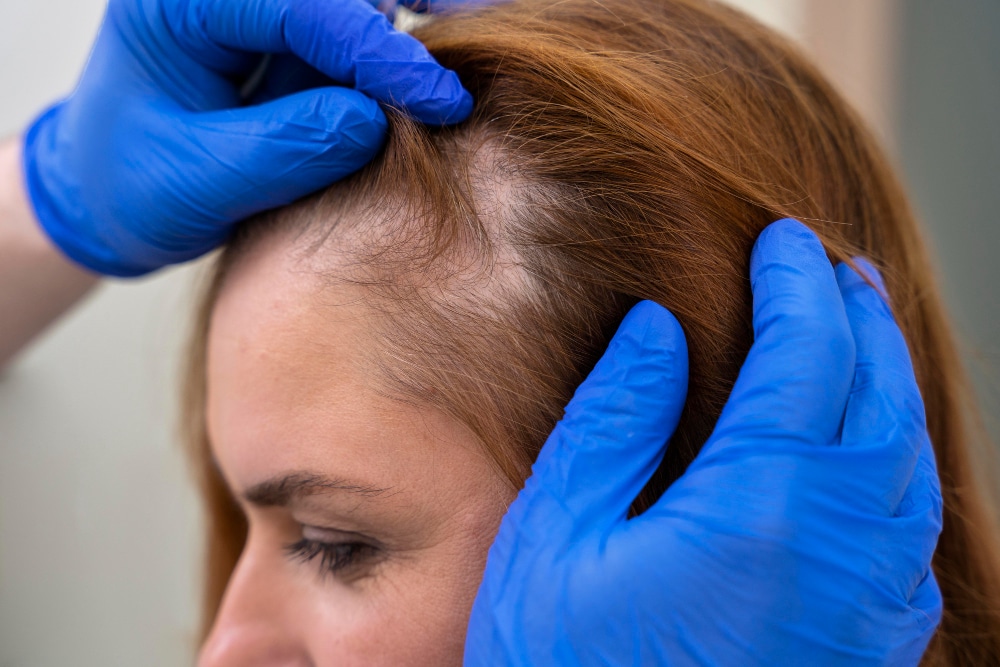 5 mitos sobre la alopecia que debes dejar de creer