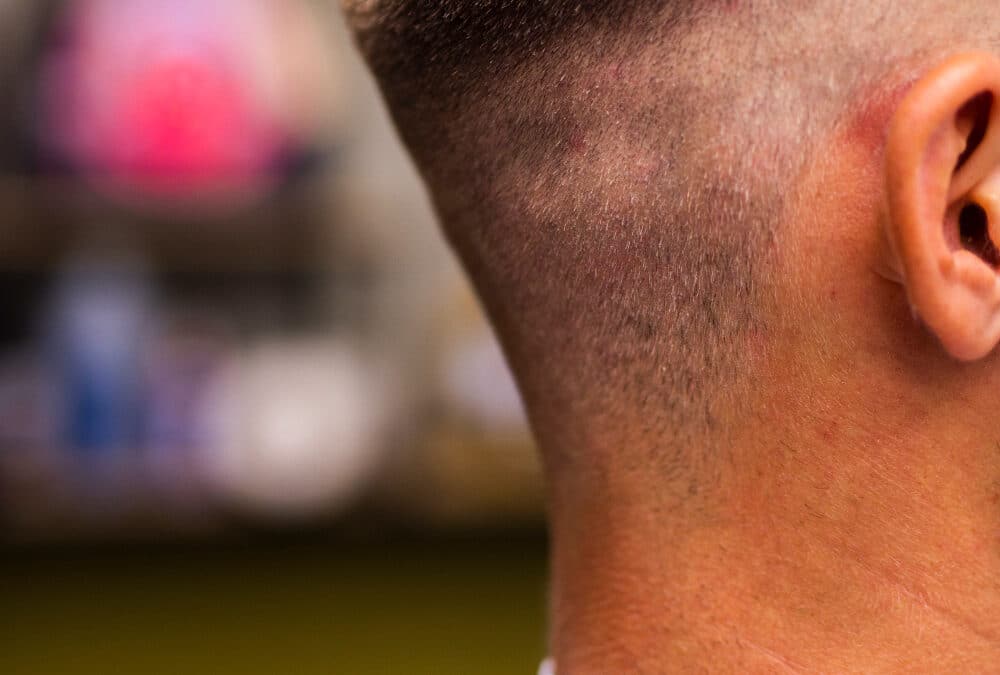 Injerto capilar en cicatrices: ¿es posible recuperar el cabello perdido?