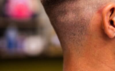 Injerto capilar en cicatrices: ¿es posible recuperar el cabello perdido?