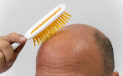 Alopecia androgenética: causas, grados y soluciones efectivas