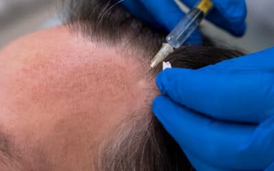 Mesoterapia capilar, ¿qué es y para qué sirve?