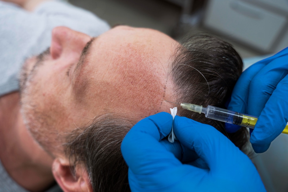 Mesoterapia con biotina beneficios reales cabello